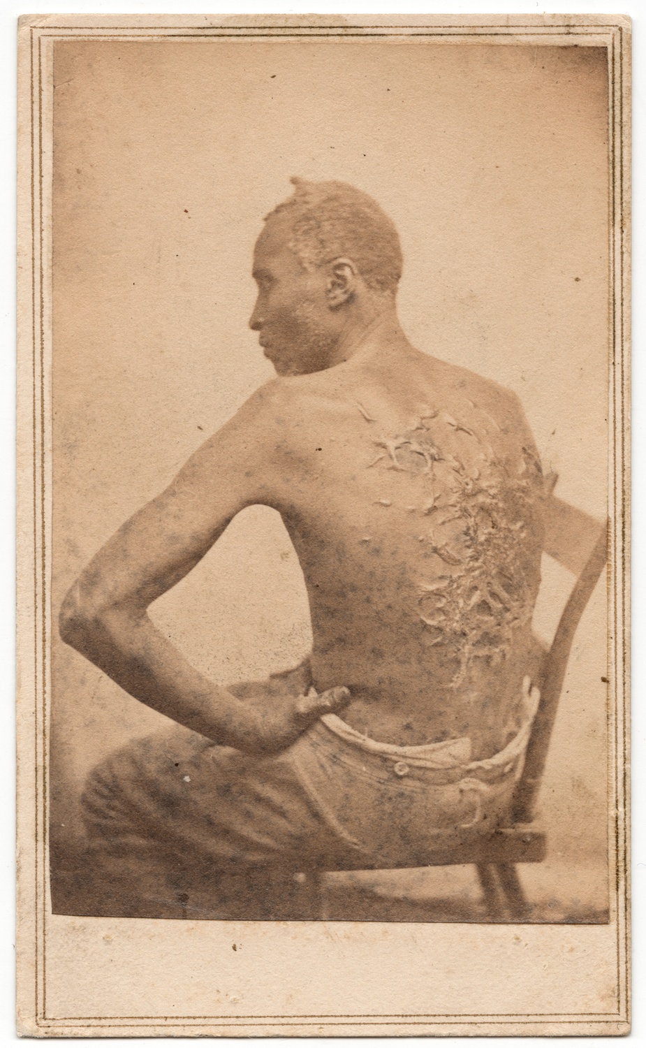 Fotografía de 1863 de Gordon, un esclavo fugado, mostrando la espalda cubierta de cicatrices